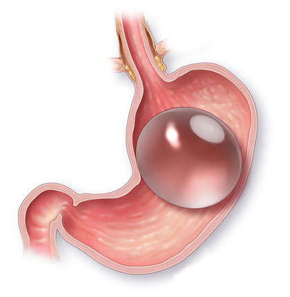 Gastric balloon