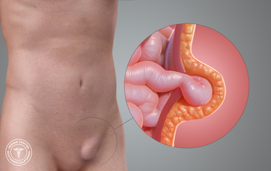 hernia