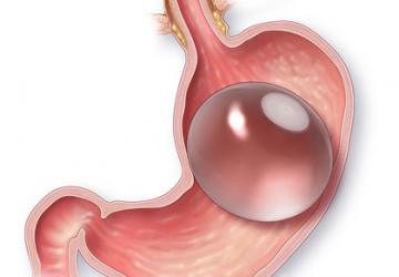 Gastric balloon
